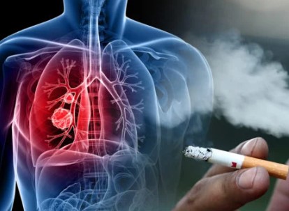 Akciğer Kanseri nedir,belirtileri,risk faktörleri,teşhis ve tedavisi