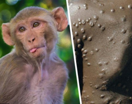 Maymun çiçeği: Tüm Dünya'yı endişelendiren hastalık